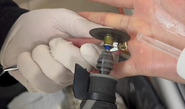 Batman'da parmağa sıkışan iki yüzük 'spiral makine' ile çıkarıldı