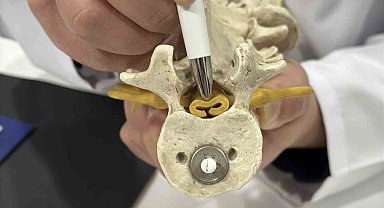 Beldeki gizli tehlike: Spinal stenoz