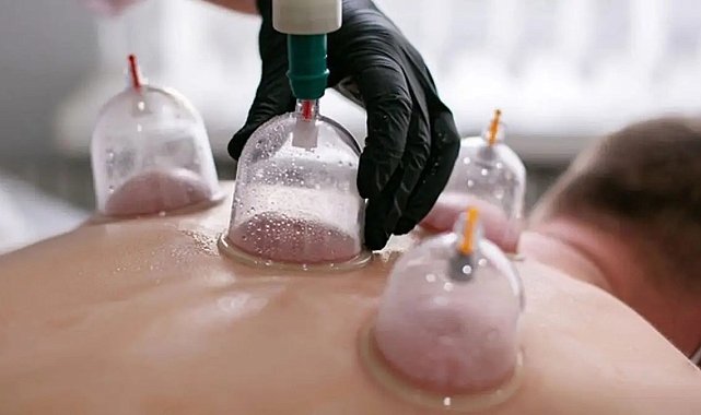 Hacamat uygulamasında hekim kontrolü ve steril ortamda yapılmalı