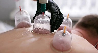 Hacamat uygulamasında hekim kontrolü ve steril ortamda yapılmalı